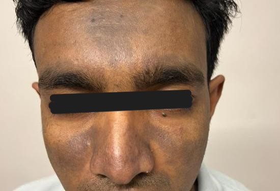 Treatment Procedure